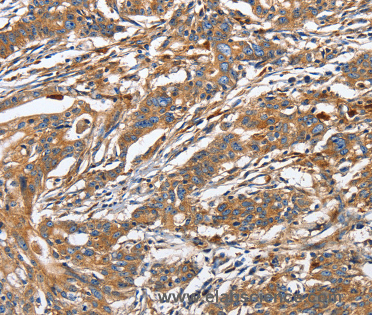 Immunohistochemistry of paraffin-embedded Human gastric cancer using GNA13 Polyclonal Antibody at dilution of 1:30