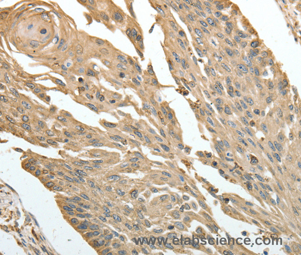 Immunohistochemistry of paraffin-embedded Human cervical cancer using HSP90B1 Polyclonal Antibody at dilution of 1:30