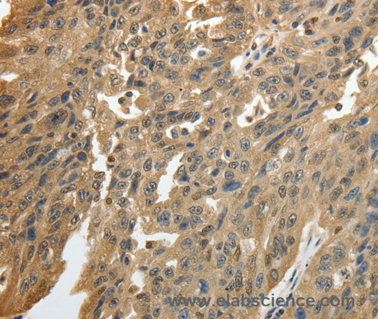 Immunohistochemistry of paraffin-embedded Human ovarian cancer using GSR Polyclonal Antibody at dilution of 1:50