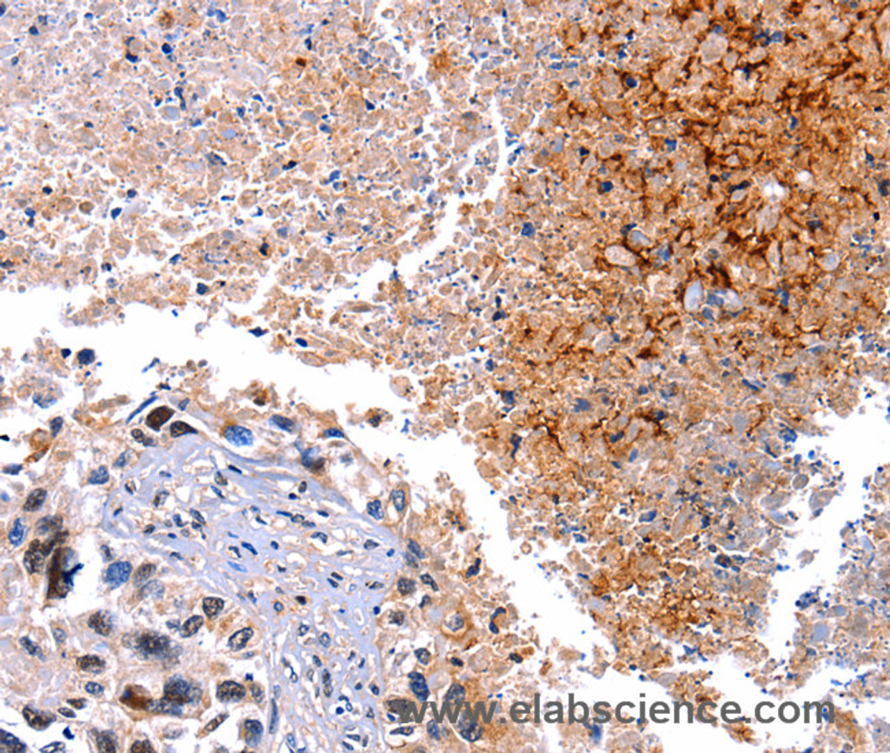 Immunohistochemistry of paraffin-embedded Human lung cancer tissue using HMOX1 Polyclonal Antibody at dilution 1:40