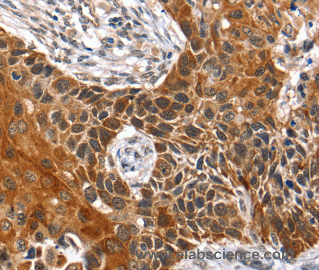 Immunohistochemistry of paraffin-embedded Human esophagus cancer tissue using HOXB1 Polyclonal Antibody at dilution 1:40