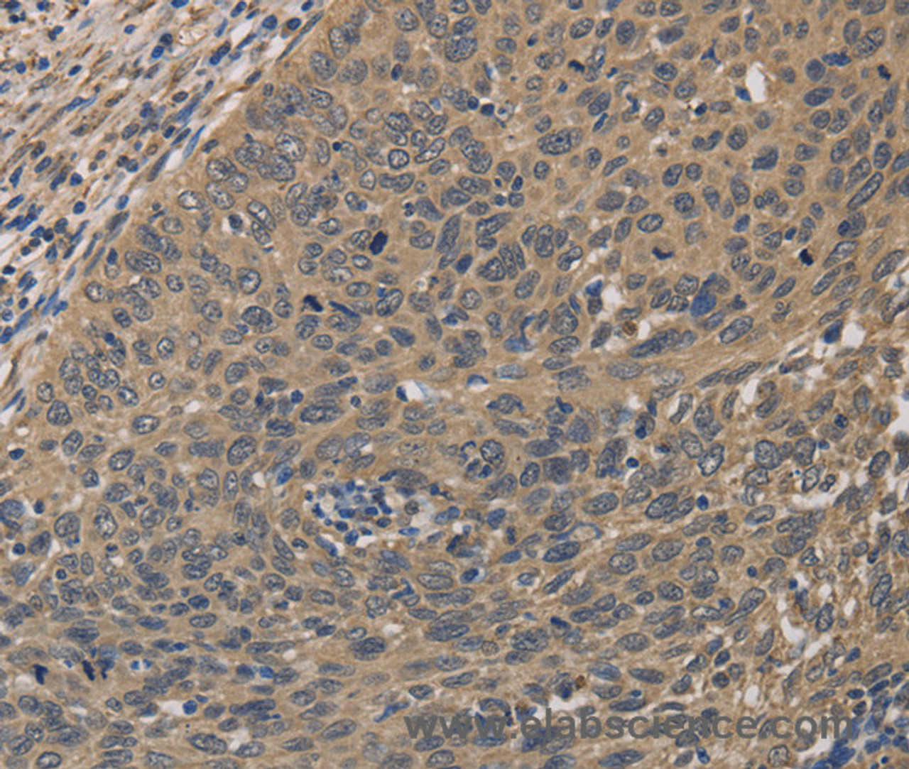 Immunohistochemistry of paraffin-embedded Human cervical cancer tissue using HSF1 Polyclonal Antibody at dilution 1:60