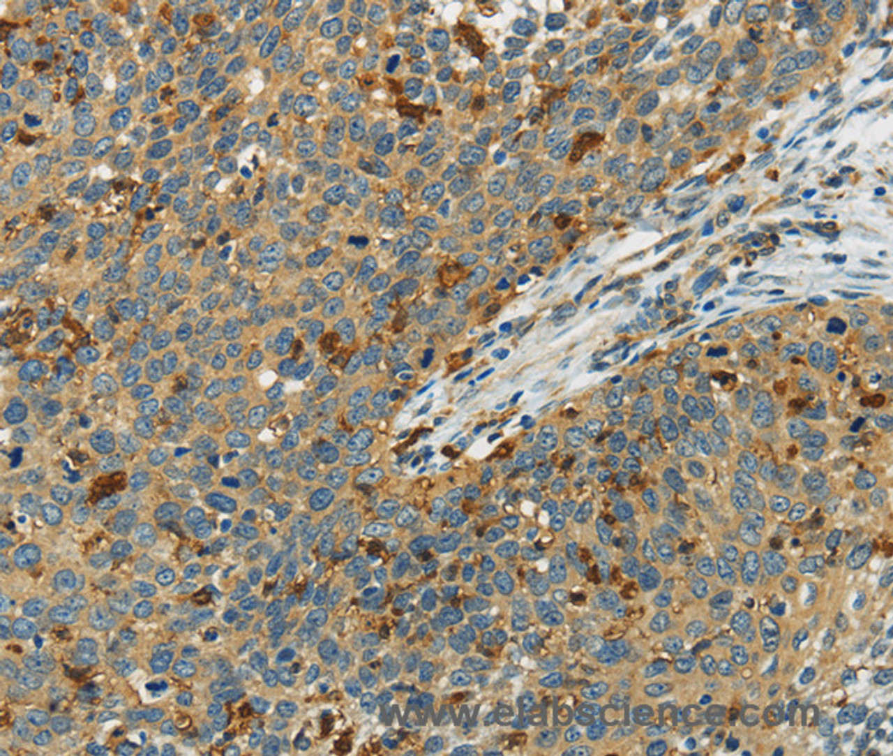 Immunohistochemistry of paraffin-embedded Human cervical cancer using AIF1 Polyclonal Antibody at dilution of 1:40