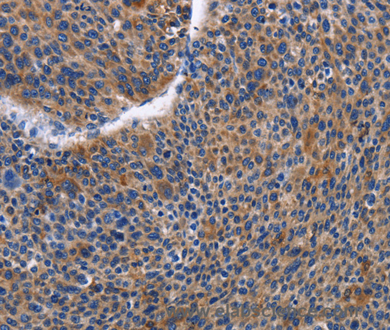 Immunohistochemistry of paraffin-embedded Human liver cancer tissue using IGSF10 Polyclonal Antibody at dilution 1:50