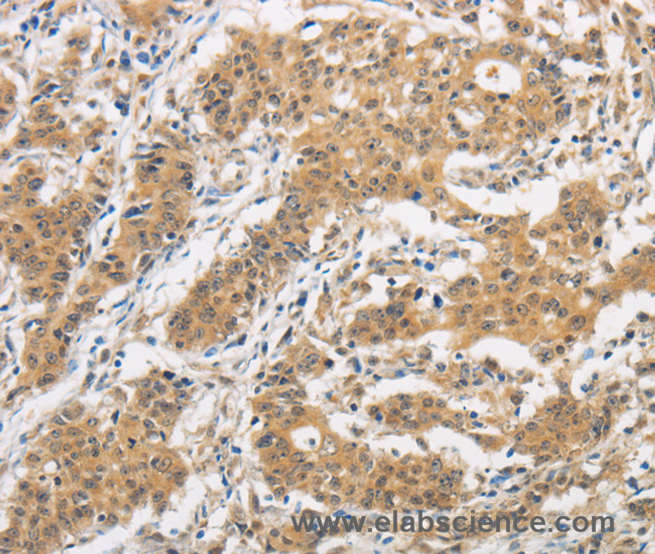 Immunohistochemistry of paraffin-embedded Human gasrtic cancer tissue using ITGB3BP Polyclonal Antibody at dilution 1:50