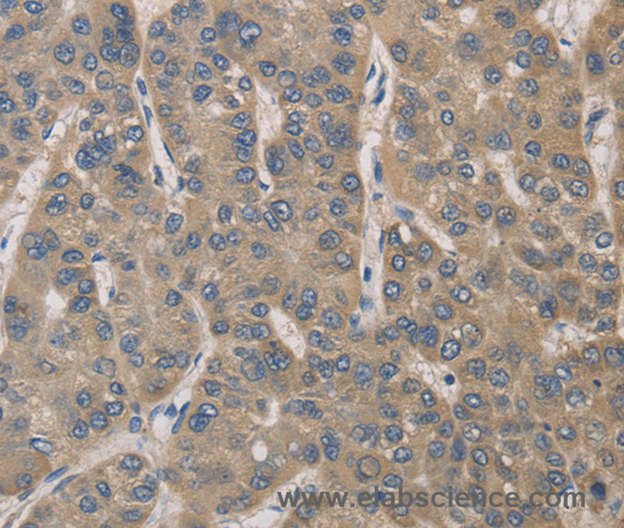 Immunohistochemistry of paraffin-embedded Human liver cancer tissue using IRAK4 Polyclonal Antibody at dilution 1:40