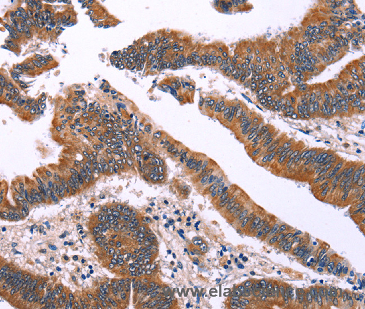 Immunohistochemistry of paraffin-embedded Human colon cancer using IRAK1BP1 Polyclonal Antibody at dilution of 1:40