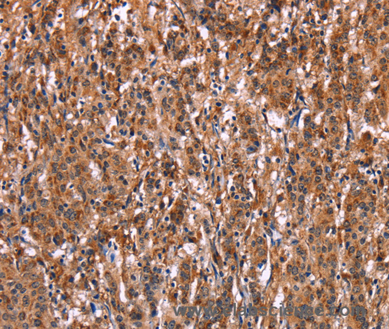 Immunohistochemistry of paraffin-embedded Human gasrtic cancer tissue using LILRB1 Polyclonal Antibody at dilution 1:50