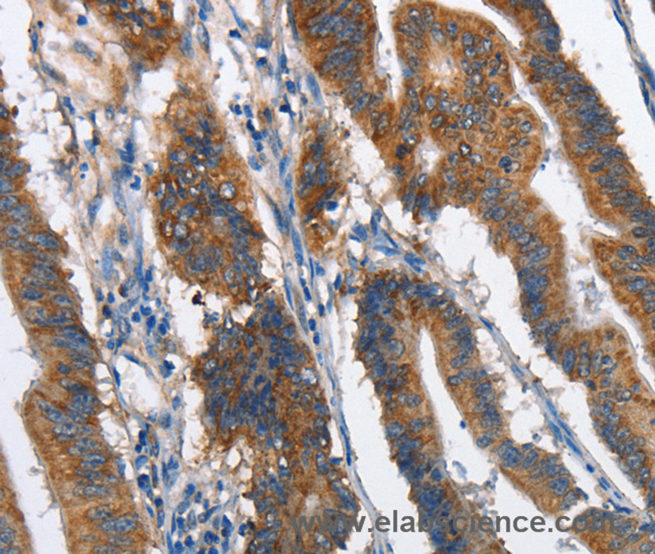 Immunohistochemistry of paraffin-embedded Human colon cancer tissue using MAD2L1BP Polyclonal Antibody at dilution 1:60