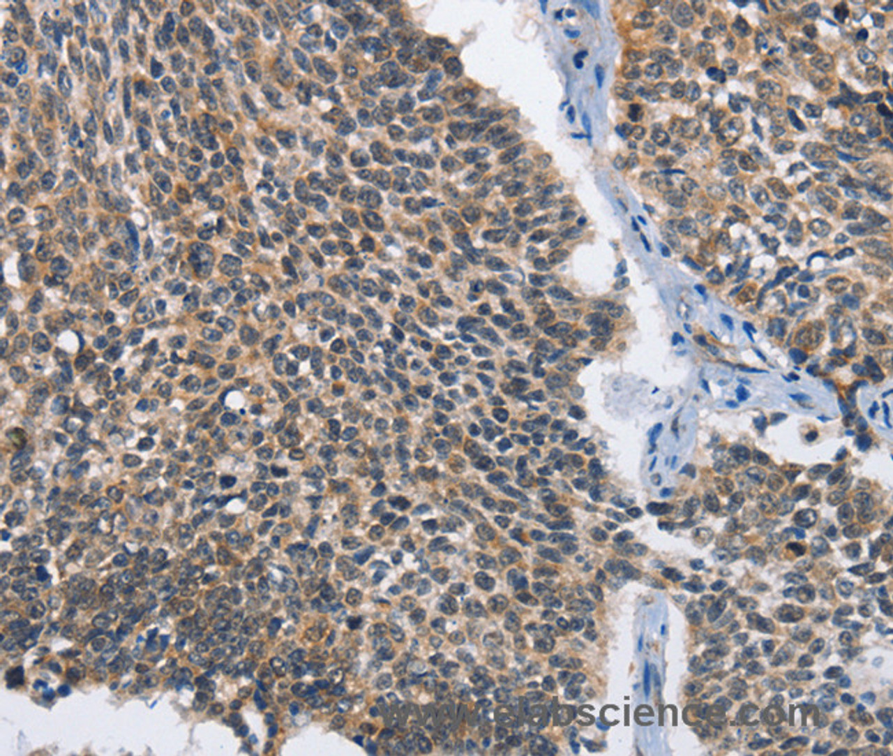 Immunohistochemistry of paraffin-embedded Human lung cancer tissue using MAD2L1BP Polyclonal Antibody at dilution 1:60