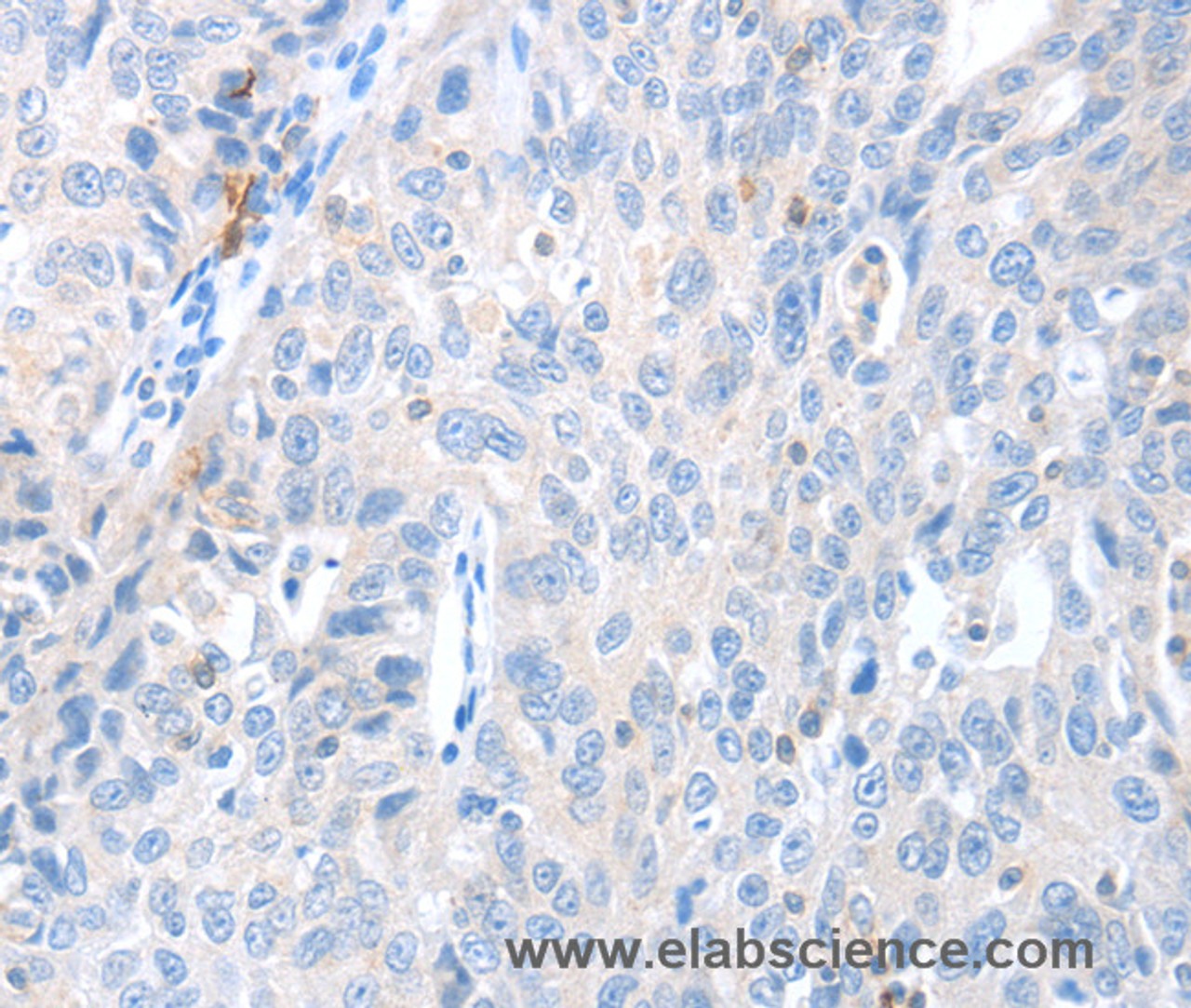 Immunohistochemistry of paraffin-embedded Human ovarian cancer using MAGEB4 Polyclonal Antibody at dilution of 1:40