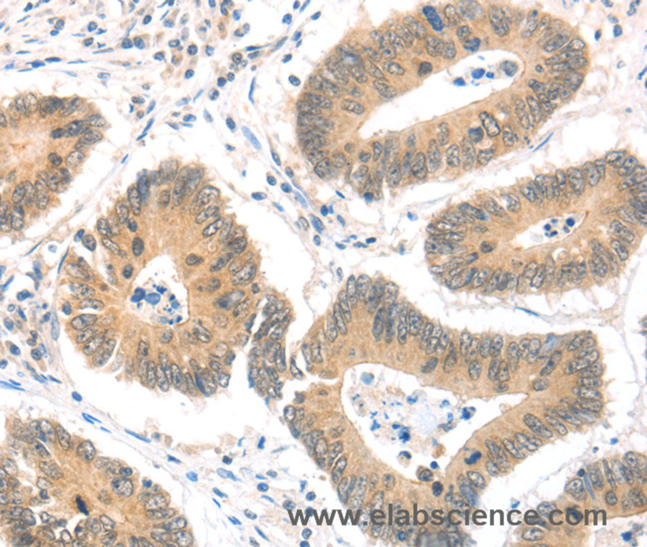 Immunohistochemistry of paraffin-embedded Human colon cancer using MAGED1 Polyclonal Antibody at dilution of 1:30