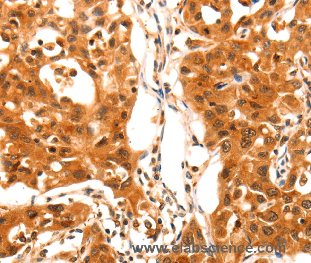 Immunohistochemistry of paraffin-embedded Human lung cancer using SERPINB5 Polyclonal Antibody at dilution of 1:60