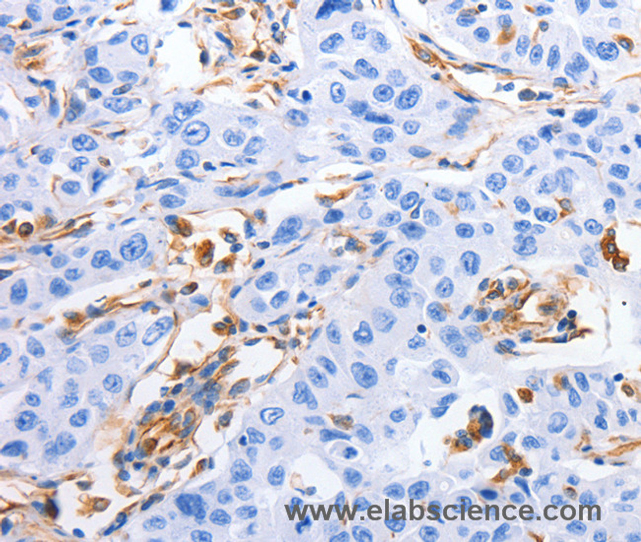 Immunohistochemistry of paraffin-embedded Human lung cancer tissue using MFN1 Polyclonal Antibody at dilution 1:60