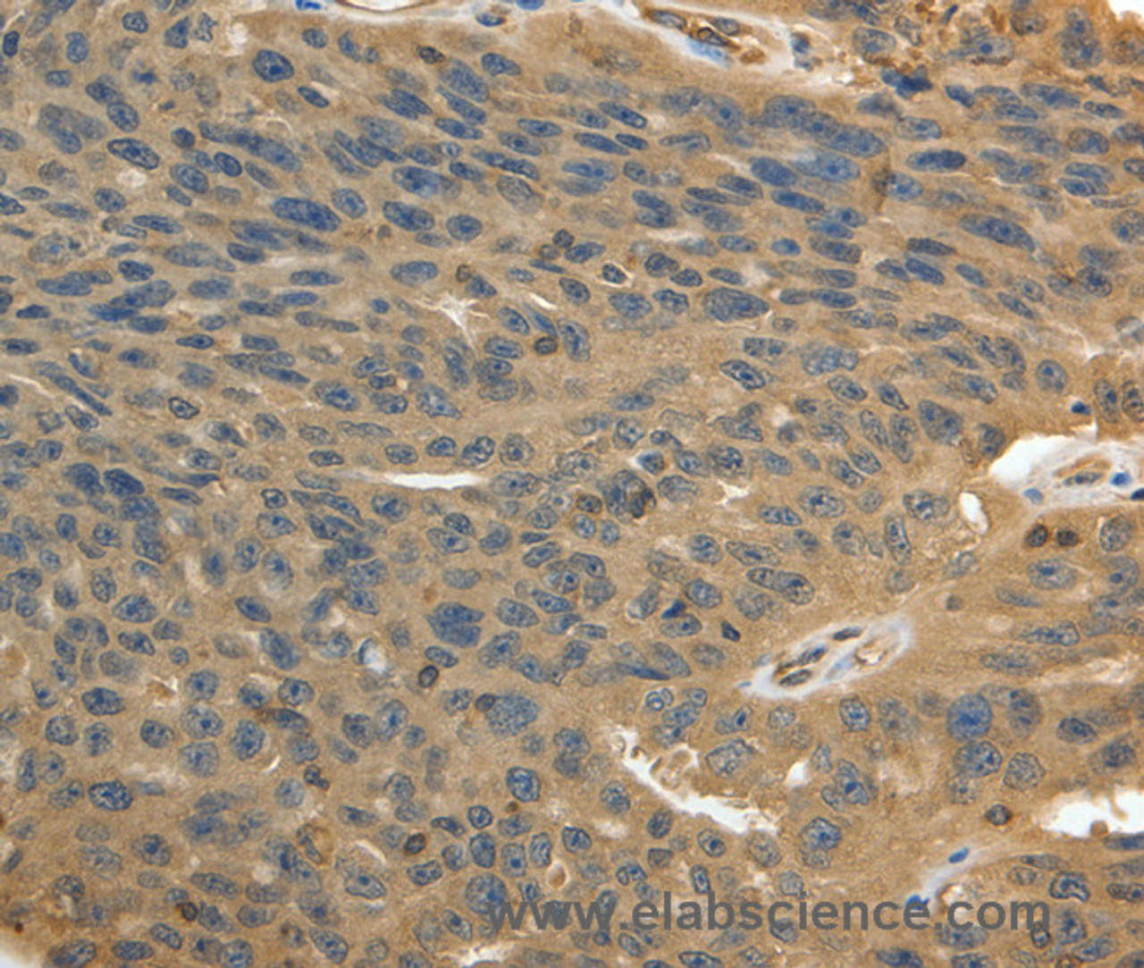 Immunohistochemistry of paraffin-embedded Human ovarian cancer using MSN Polyclonal Antibody at dilution of 1:30