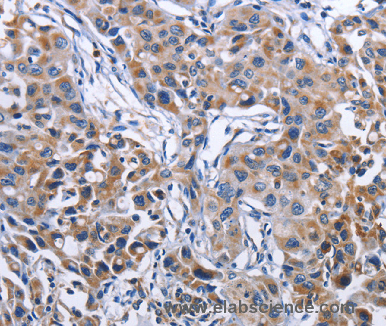 Immunohistochemistry of paraffin-embedded Human lung cancer tissue using MPO Polyclonal Antibody at dilution 1:50