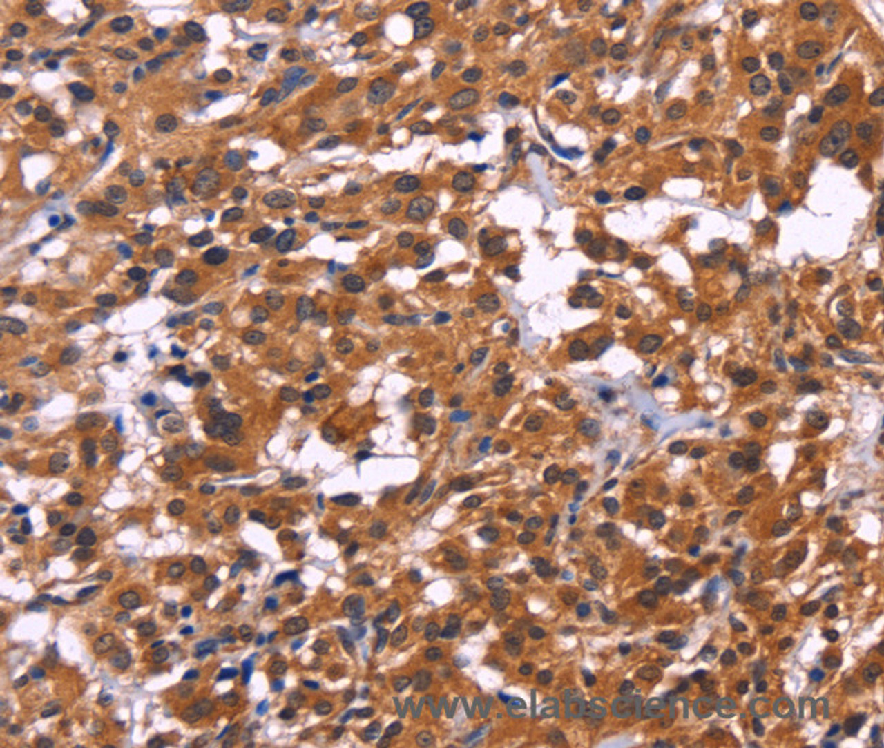 Immunohistochemistry of paraffin-embedded Human thyroid cancer tissue using MSH4 Polyclonal Antibody at dilution 1:30