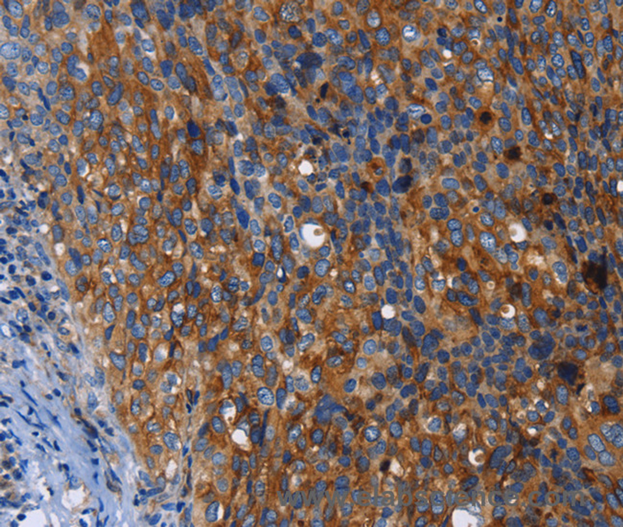 Immunohistochemistry of paraffin-embedded Human cervical cancer tissue using MSLN Polyclonal Antibody at dilution 1:50