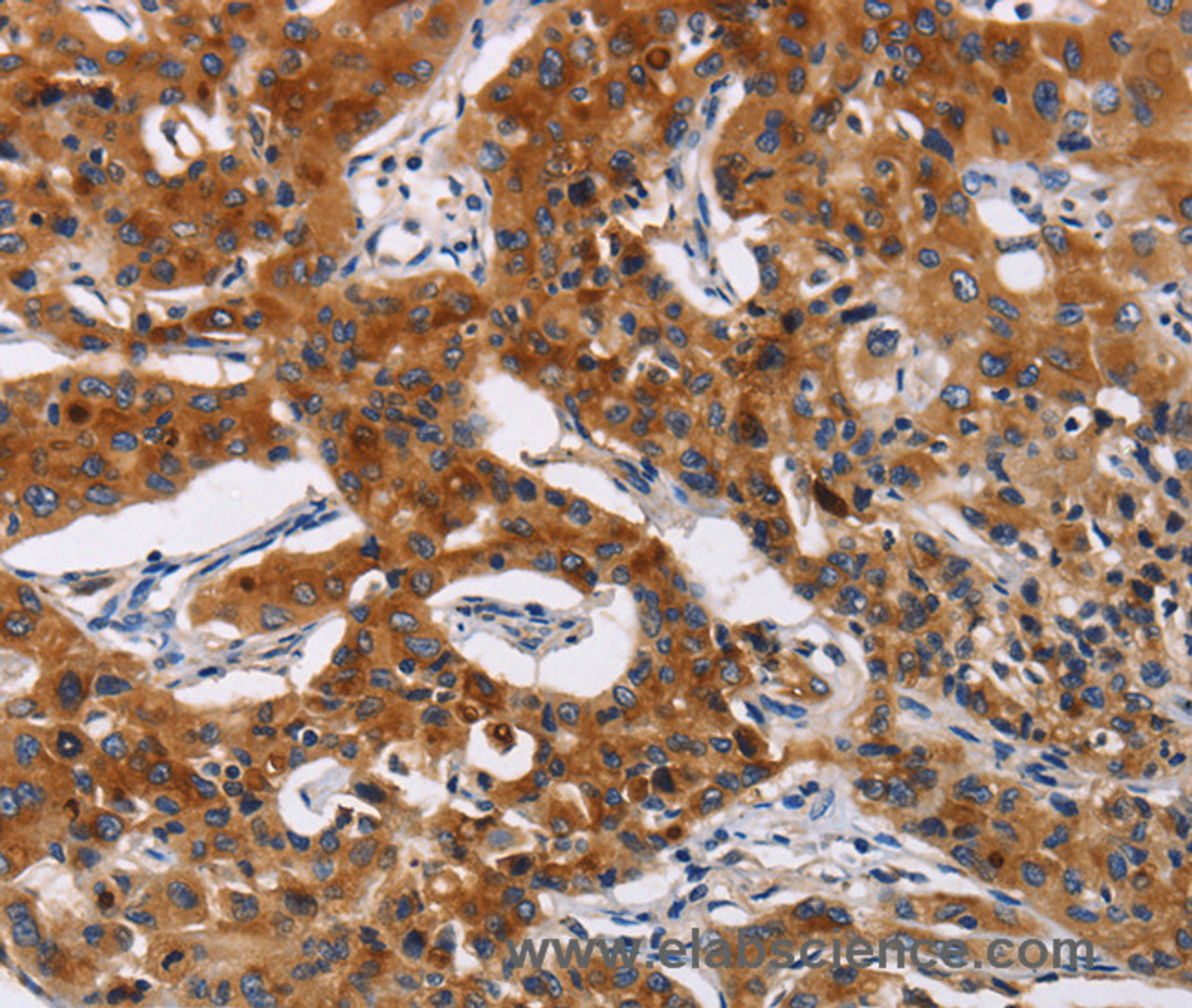 Immunohistochemistry of paraffin-embedded Human lung cancer tissue using MSLN Polyclonal Antibody at dilution 1:50