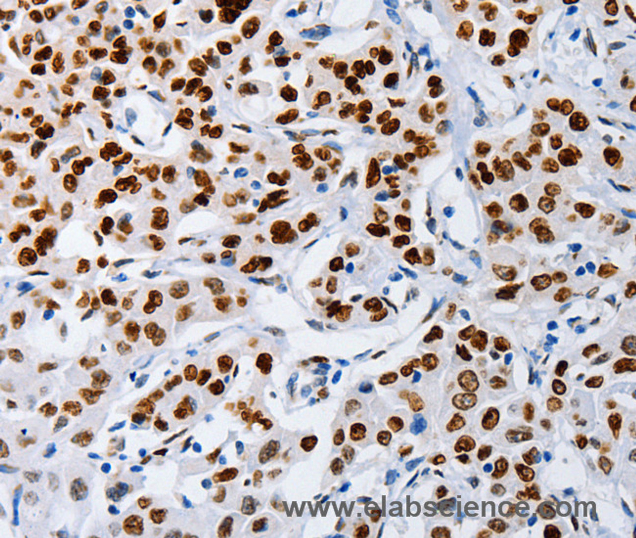 Immunohistochemistry of paraffin-embedded Human lung cancer using MUTYH Polyclonal Antibody at dilution of 1:60