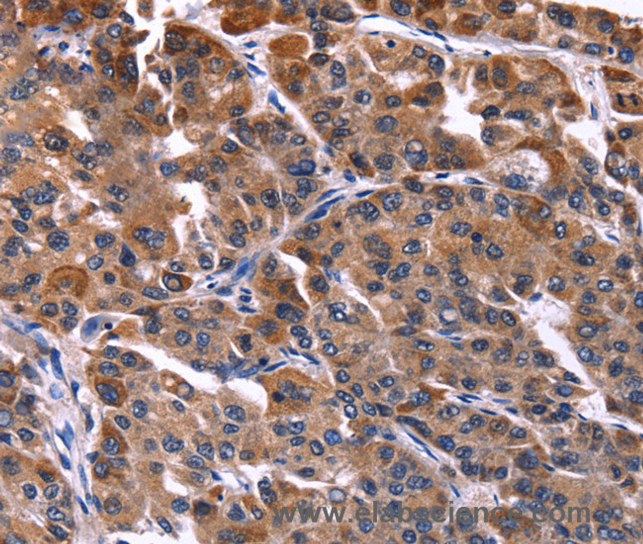 Immunohistochemistry of paraffin-embedded Human liver cancer tissue using NFATC3 Polyclonal Antibody at dilution 1:50