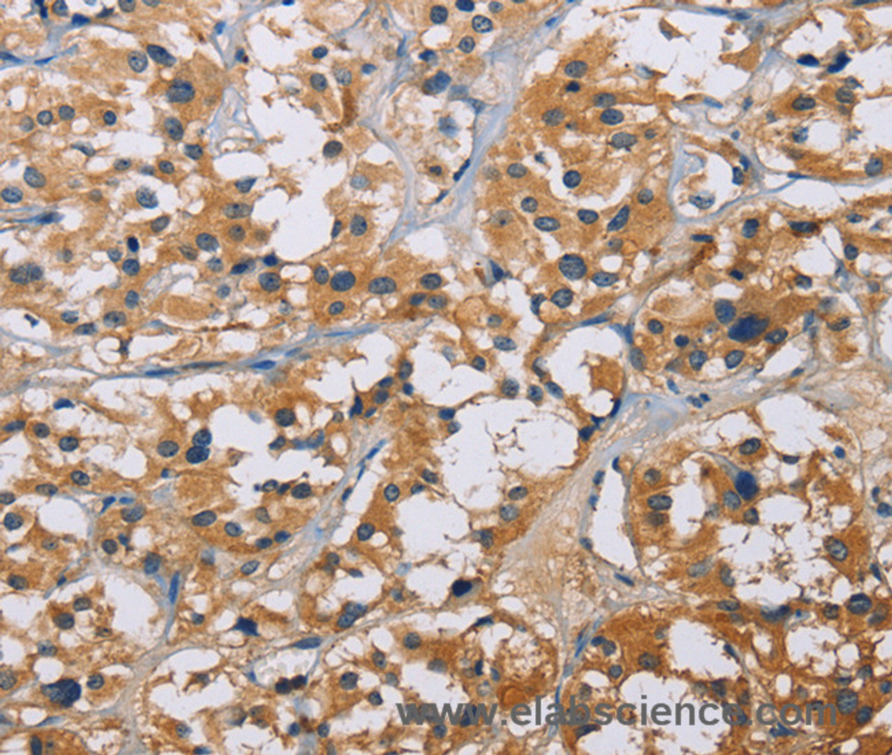 Immunohistochemistry of paraffin-embedded Human thyroid cancer tissue using NME5 Polyclonal Antibody at dilution 1:50