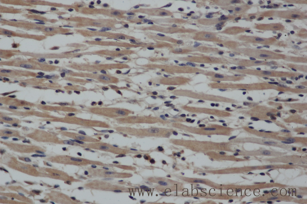 Immunohistochemistry of paraffin-embedded Human gasrtic cancer tissue using NOS2 Polyclonal Antibody at dilution 1:40