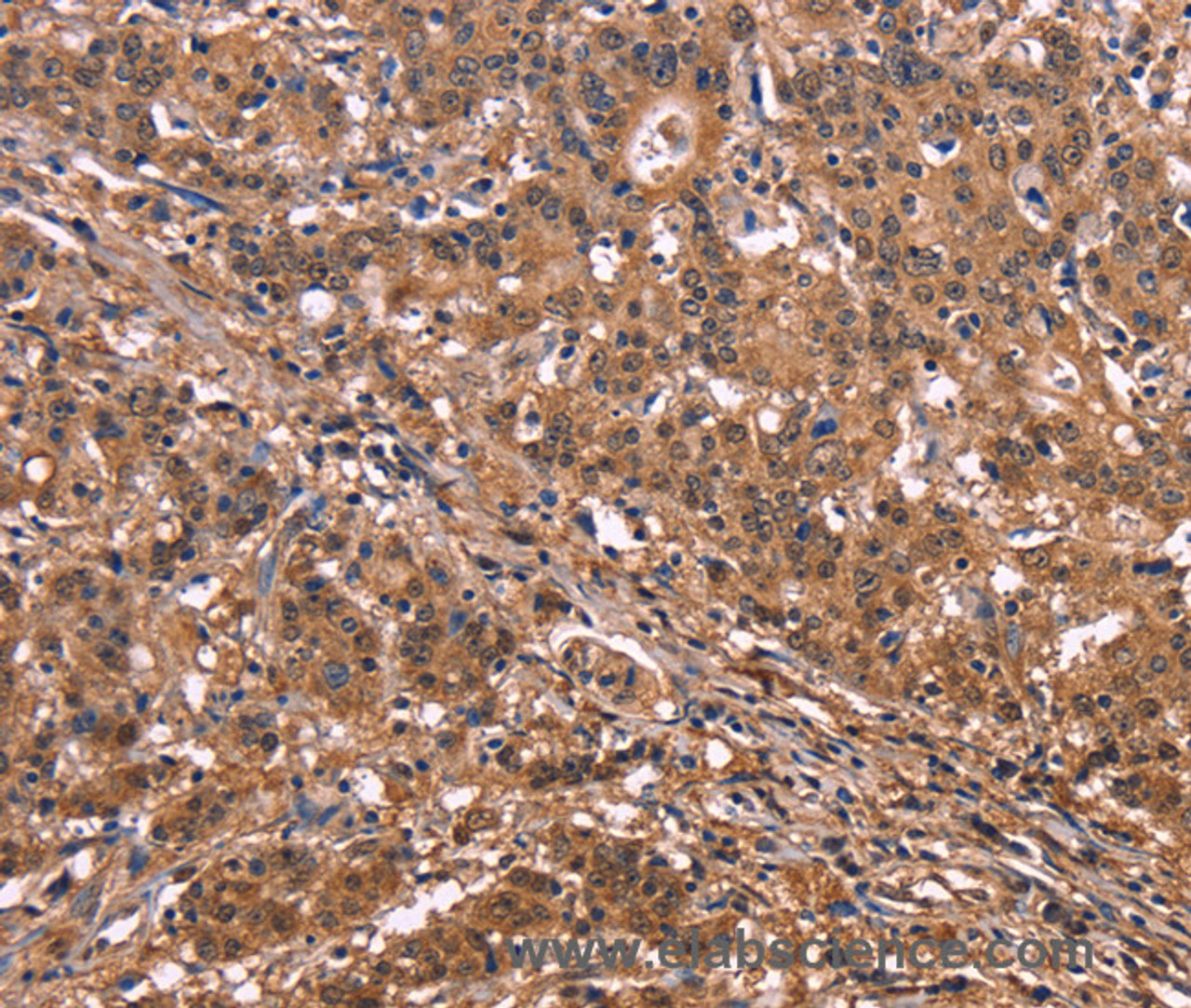 Immunohistochemistry of paraffin-embedded Human liver cancer tissue using NOS2 Polyclonal Antibody at dilution 1:40