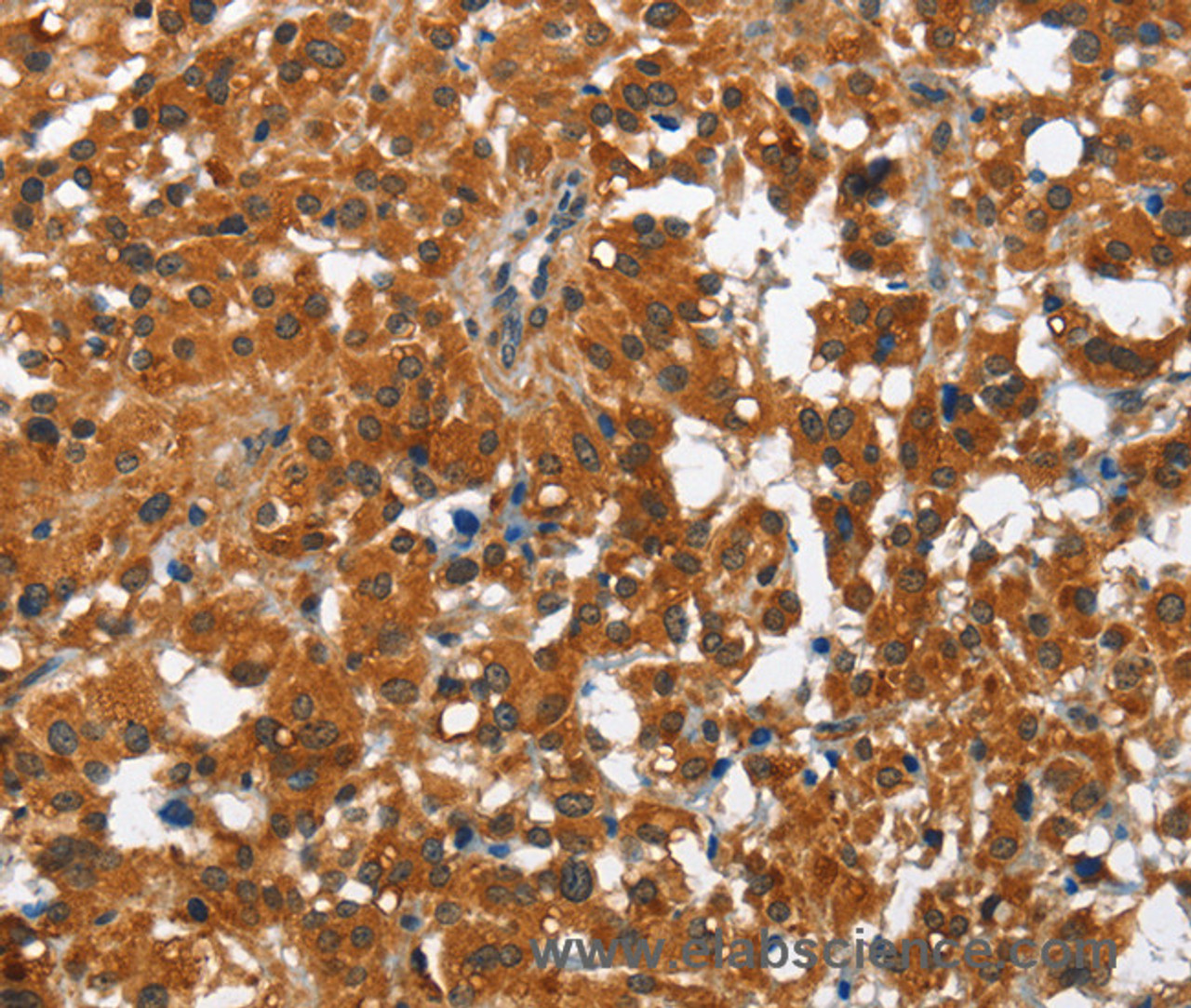 Immunohistochemistry of paraffin-embedded Human thyroid cancer tissue using PAK2 Polyclonal Antibody at dilution 1:50