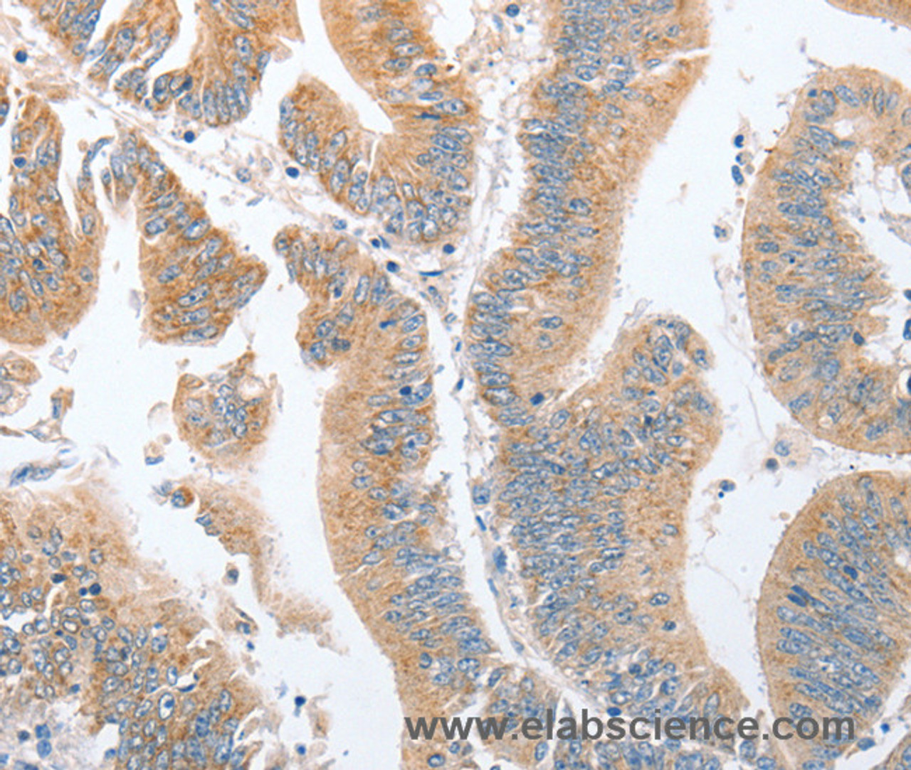 Immunohistochemistry of paraffin-embedded Human colon cancer tissue using PARD6A Polyclonal Antibody at dilution 1:60