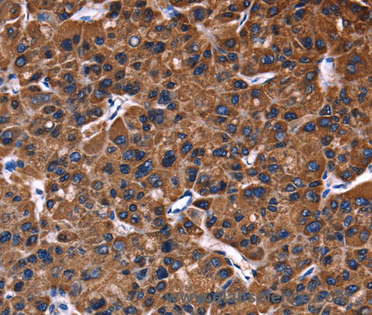 Immunohistochemistry of paraffin-embedded Human liver cancer using PHB Polyclonal Antibody at dilution of 1:30