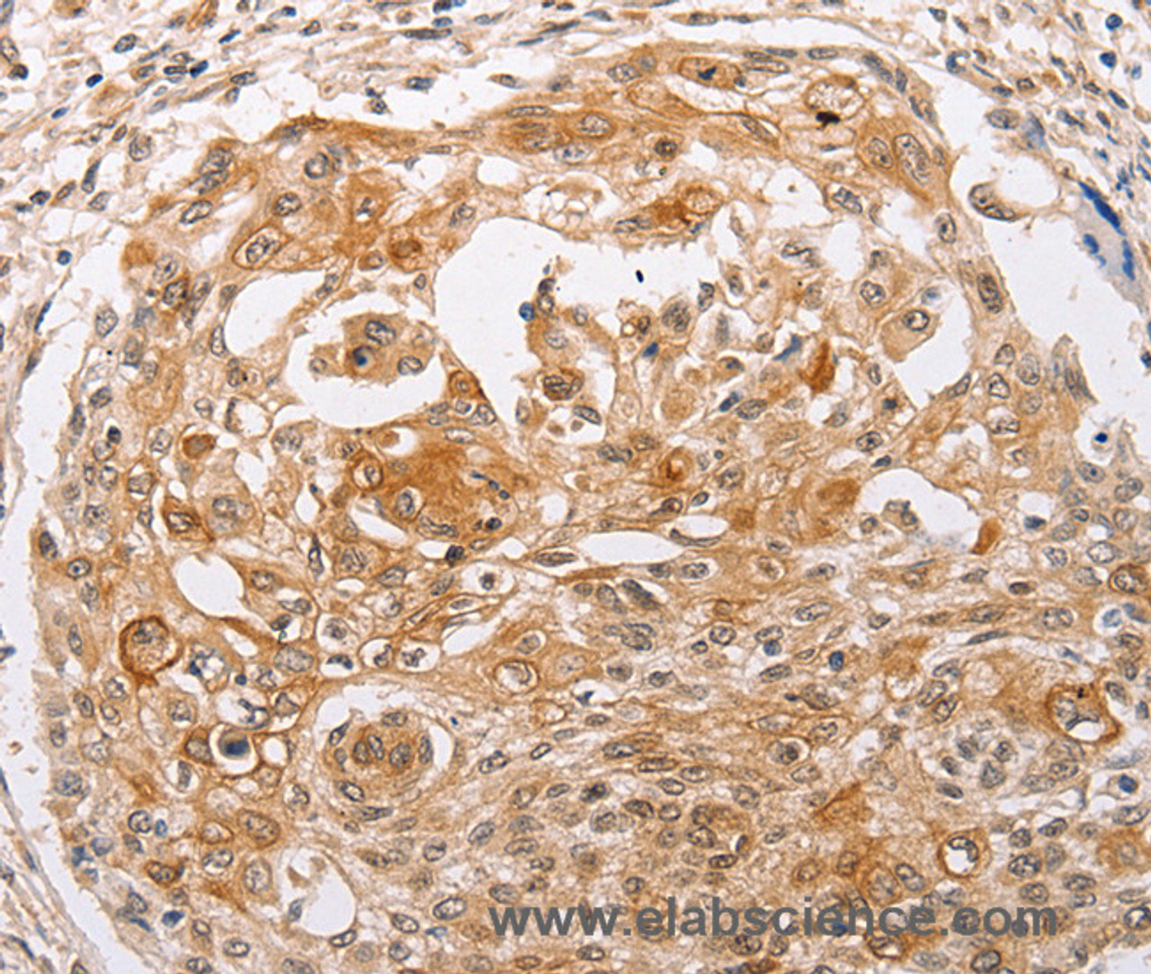 Immunohistochemistry of paraffin-embedded Human cervical cancer using PPP1CB Polyclonal Antibody at dilution of 1:30