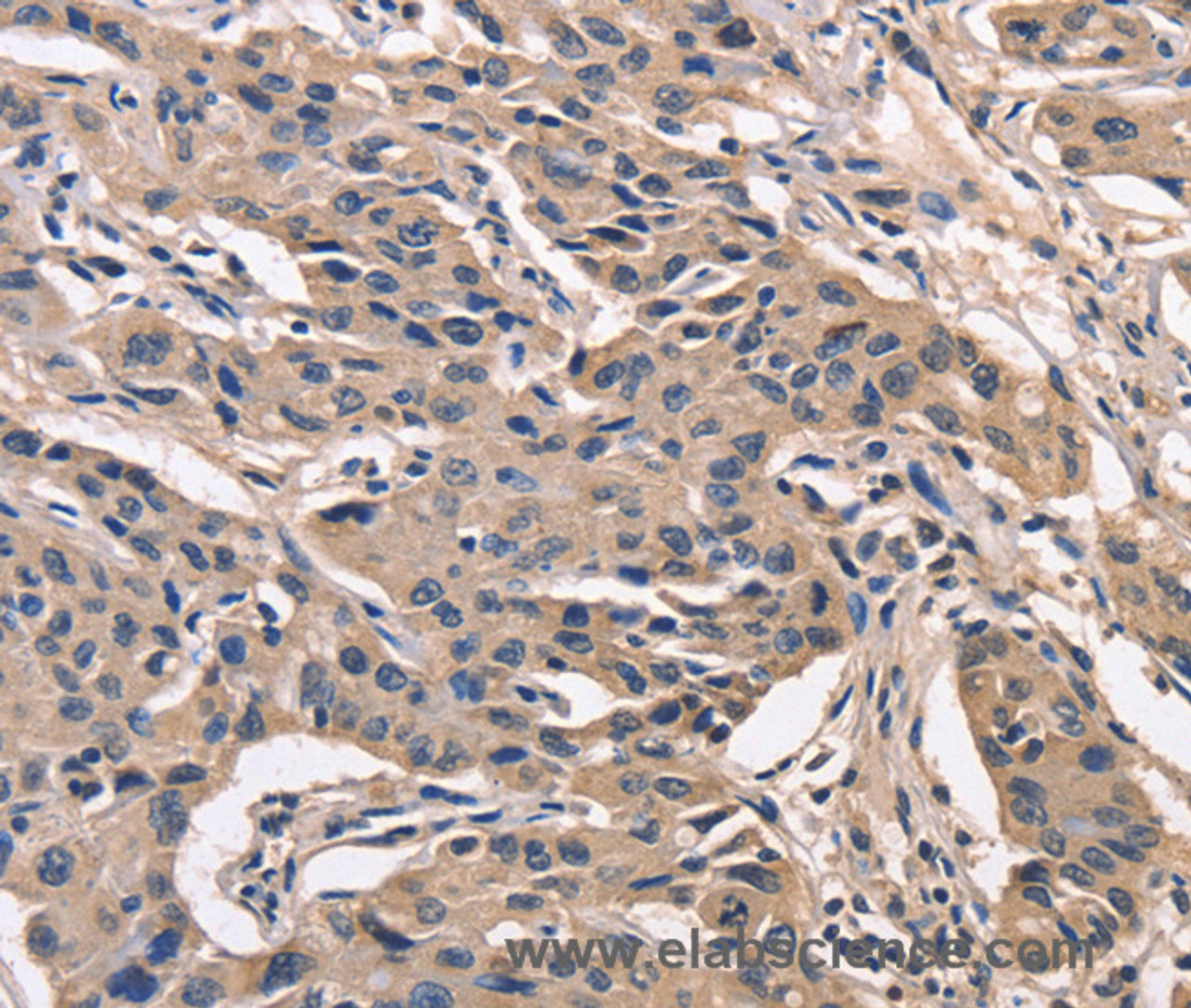 Immunohistochemistry of paraffin-embedded Human lung cancer using PEBP1 Polyclonal Antibody at dilution of 1:40