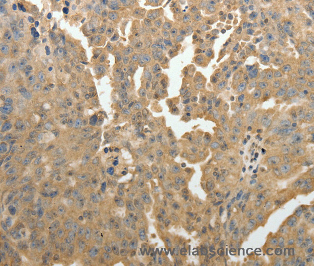 Immunohistochemistry of paraffin-embedded Human ovarian cancer using PSMD9 Polyclonal Antibody at dilution of 1:50