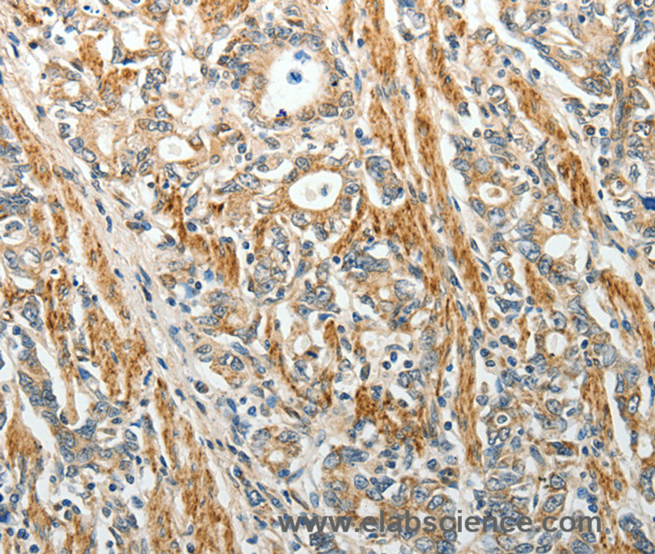 Immunohistochemistry of paraffin-embedded Human gastric cancer using E-Selectin Polyclonal Antibody at dilution of 1:40