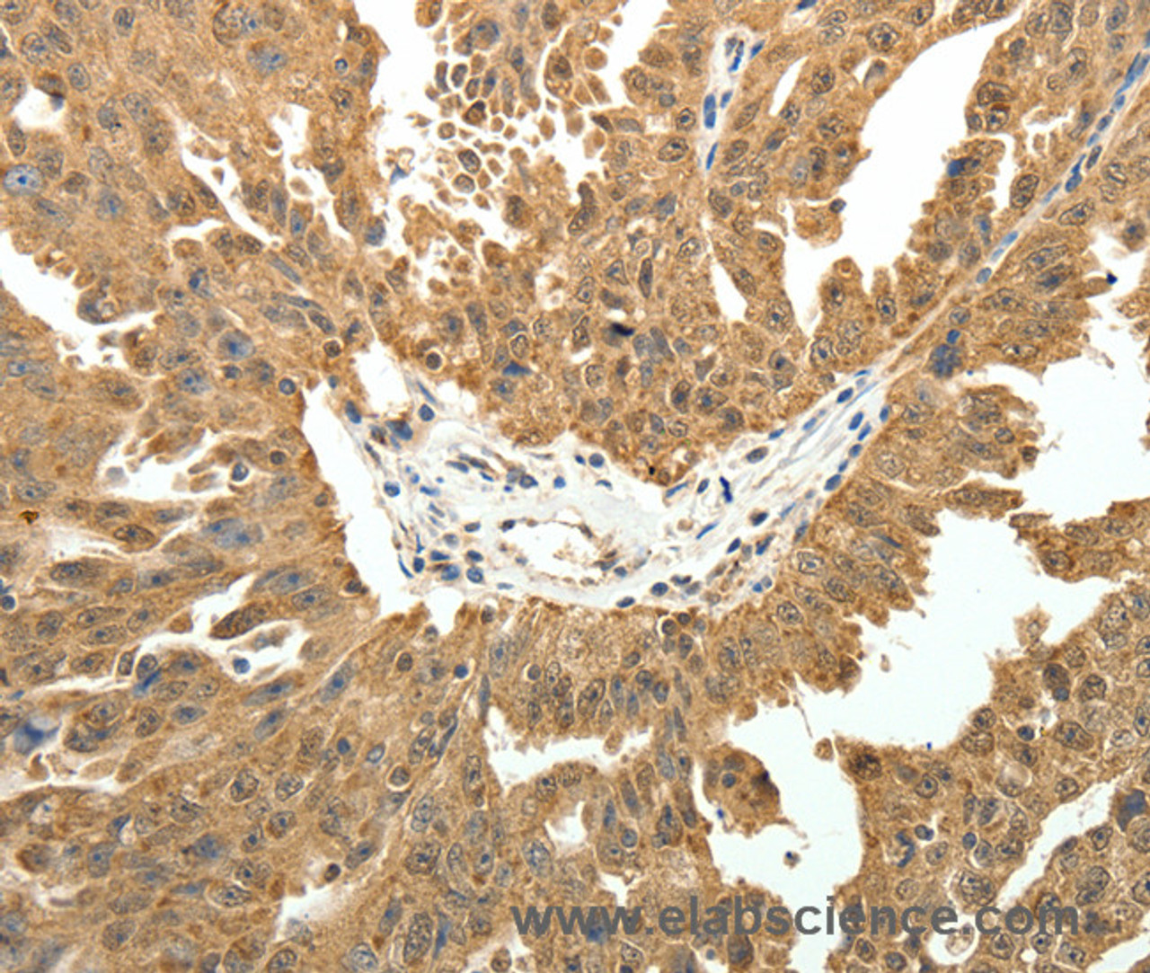 Immunohistochemistry of paraffin-embedded Human ovarian cancer using PTCH1 Polyclonal Antibody at dilution of 1:50