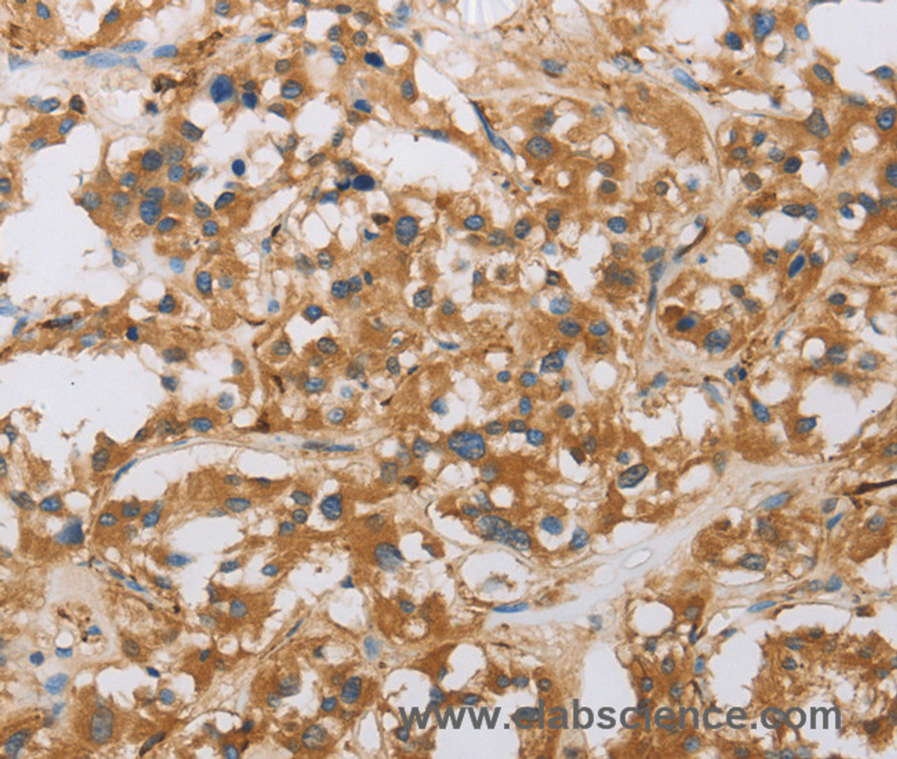 Immunohistochemistry of paraffin-embedded Human thyroid cancer tissue using RAD54L2 Polyclonal Antibody at dilution 1:40
