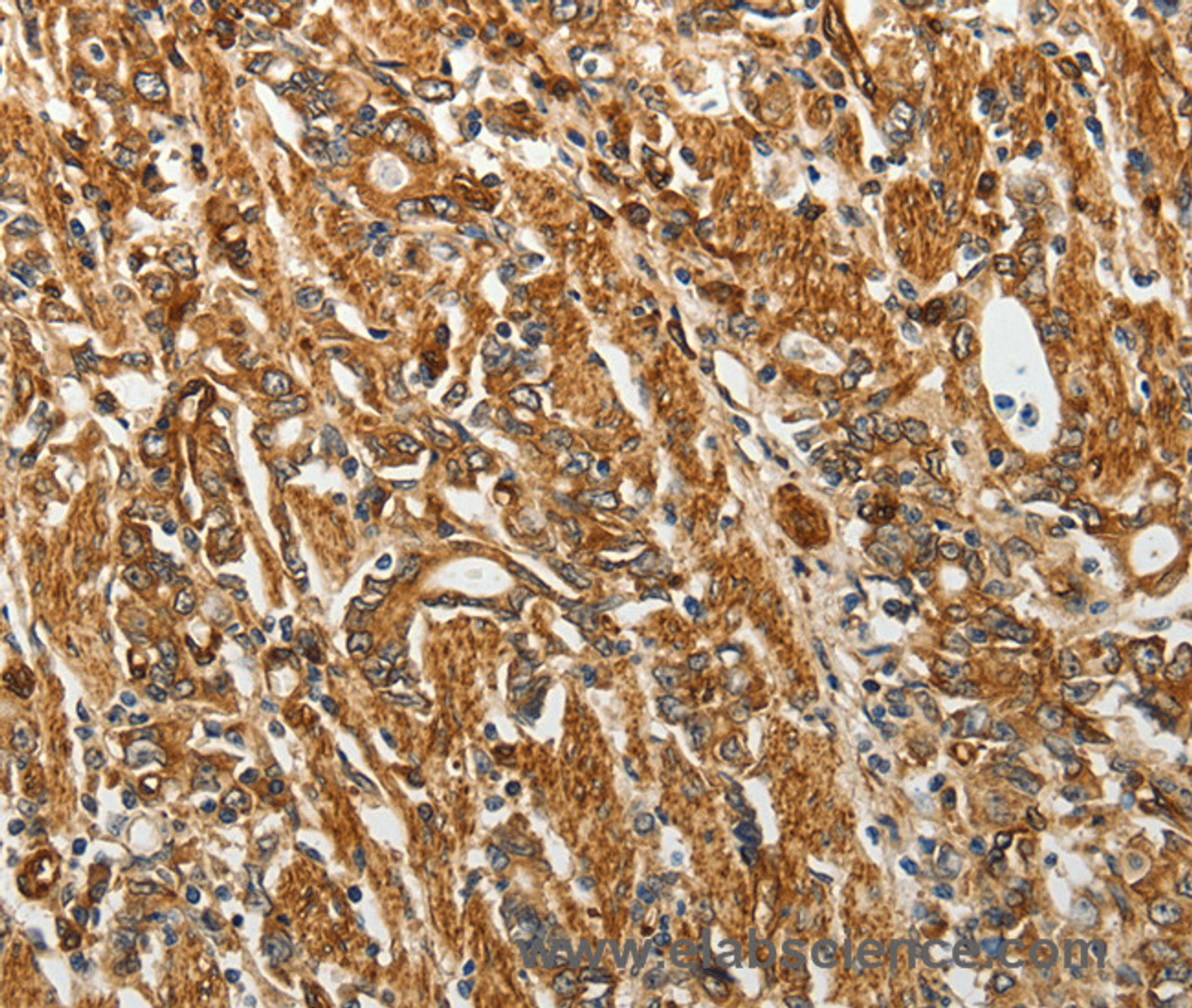 Immunohistochemistry of paraffin-embedded Human gastic cancer using RPLP0 Polyclonal Antibody at dilution of 1:40