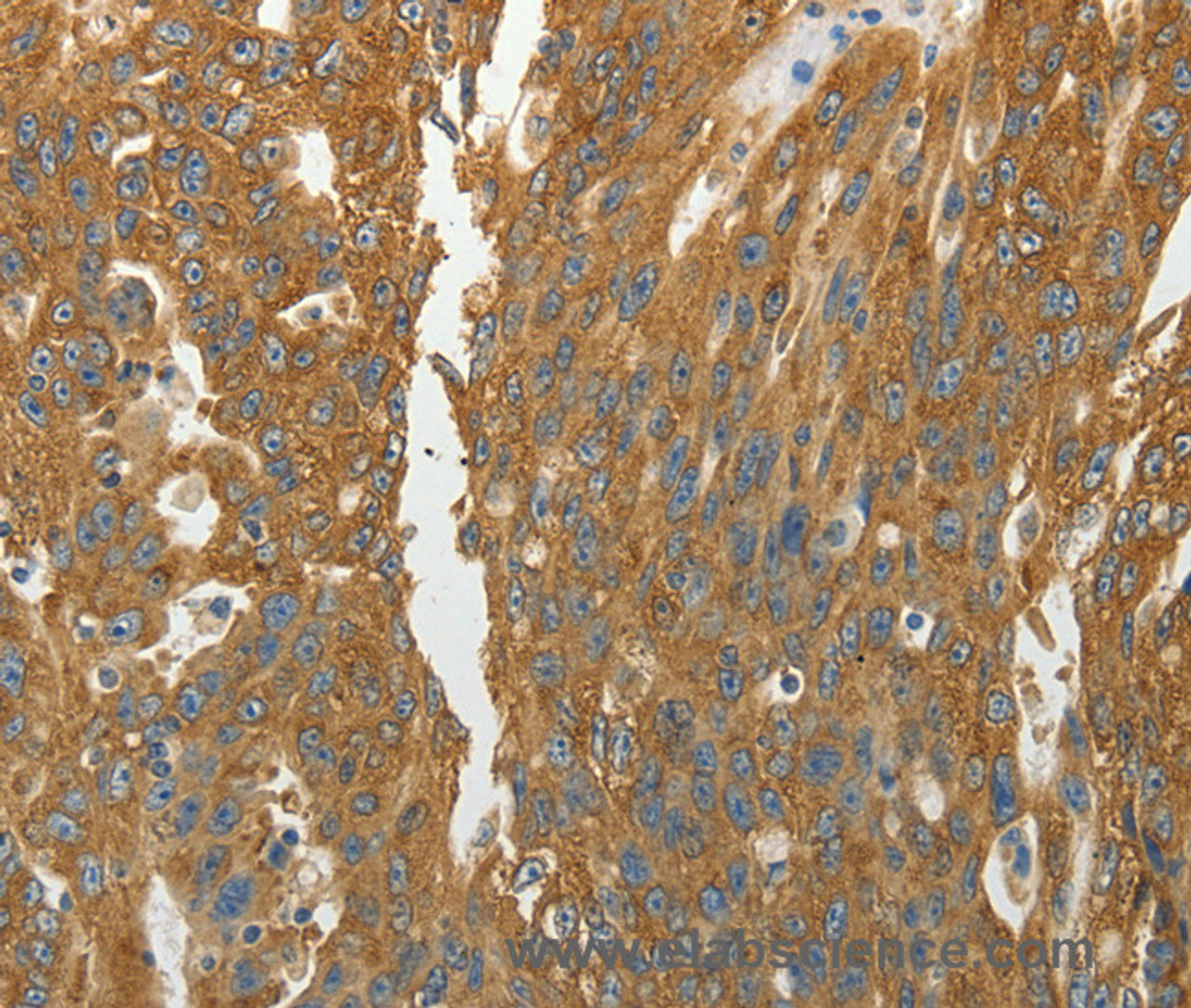 Immunohistochemistry of paraffin-embedded Human ovarian cancer using RPLP0 Polyclonal Antibody at dilution of 1:40
