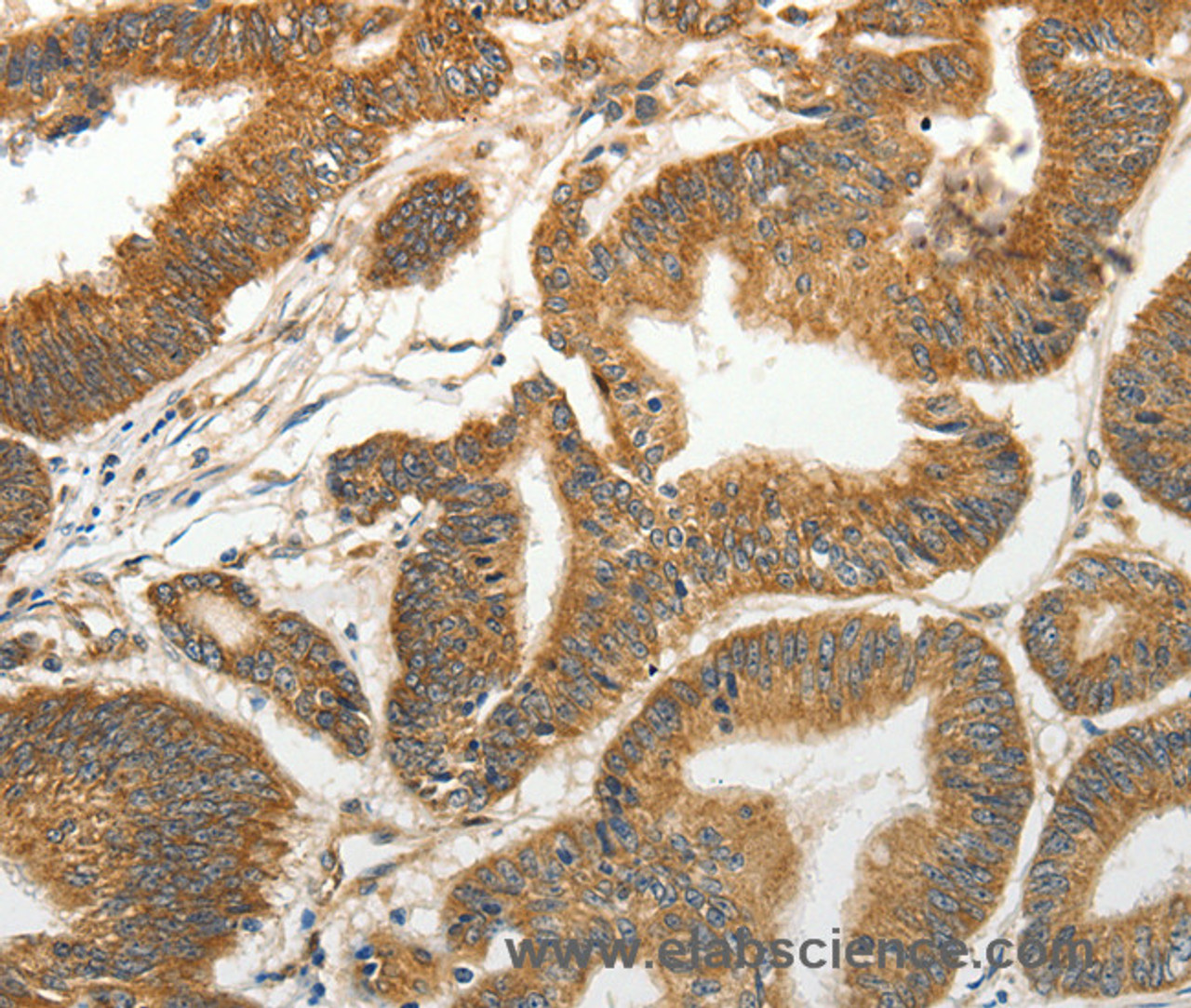 Immunohistochemistry of paraffin-embedded Human colon cancer tissue using SLC4A4 Polyclonal Antibody at dilution 1:50