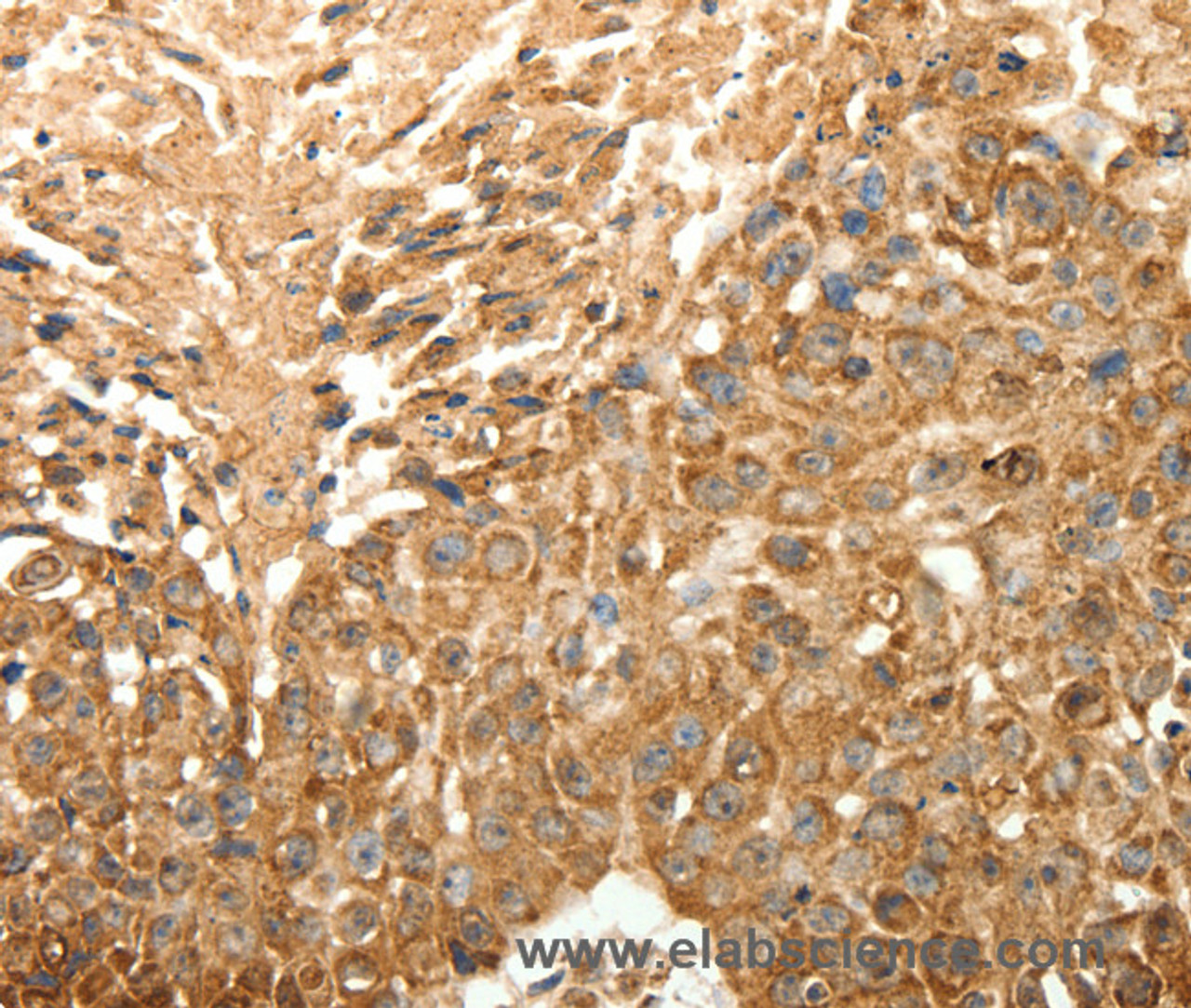 Immunohistochemistry of paraffin-embedded Human esophagus cancer using SLC25A11 Polyclonal Antibody at dilution of 1:30