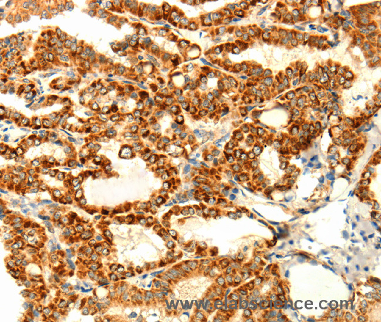 Immunohistochemistry of paraffin-embedded Human thyroid cancer using DIABLO Polyclonal Antibody at dilution of 1:70