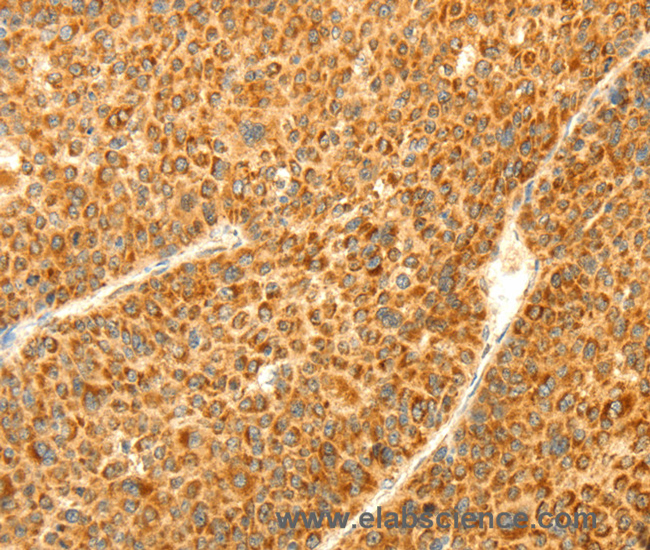 Immunohistochemistry of paraffin-embedded Human liver cancer using DIABLO Polyclonal Antibody at dilution of 1:70