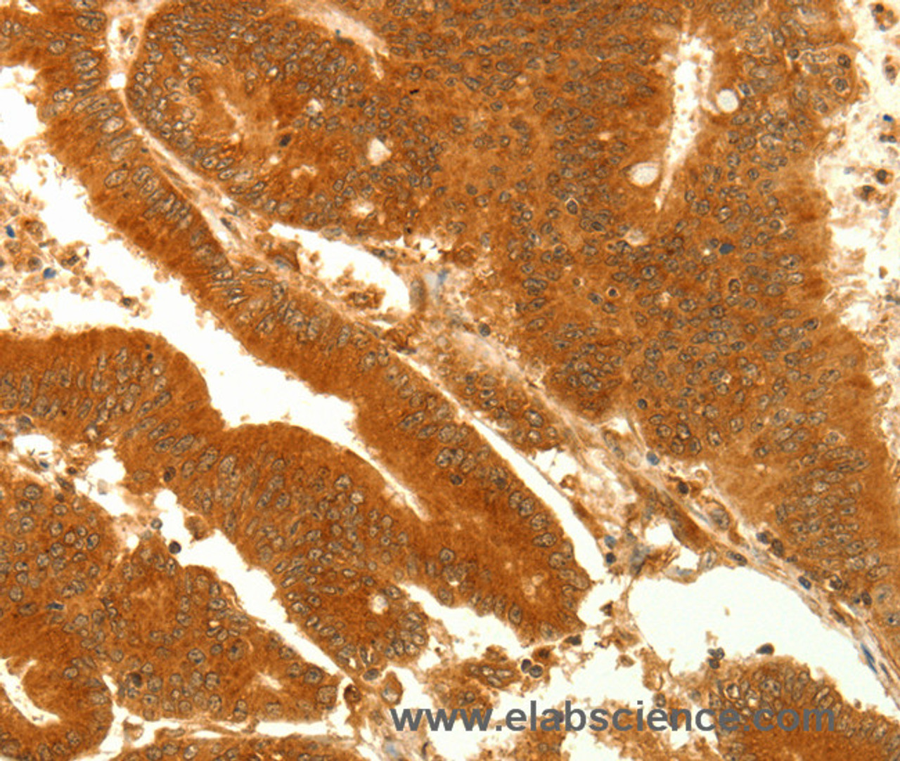 Immunohistochemistry of paraffin-embedded Human colon cancer using NAPA Polyclonal Antibody at dilution of 1:35
