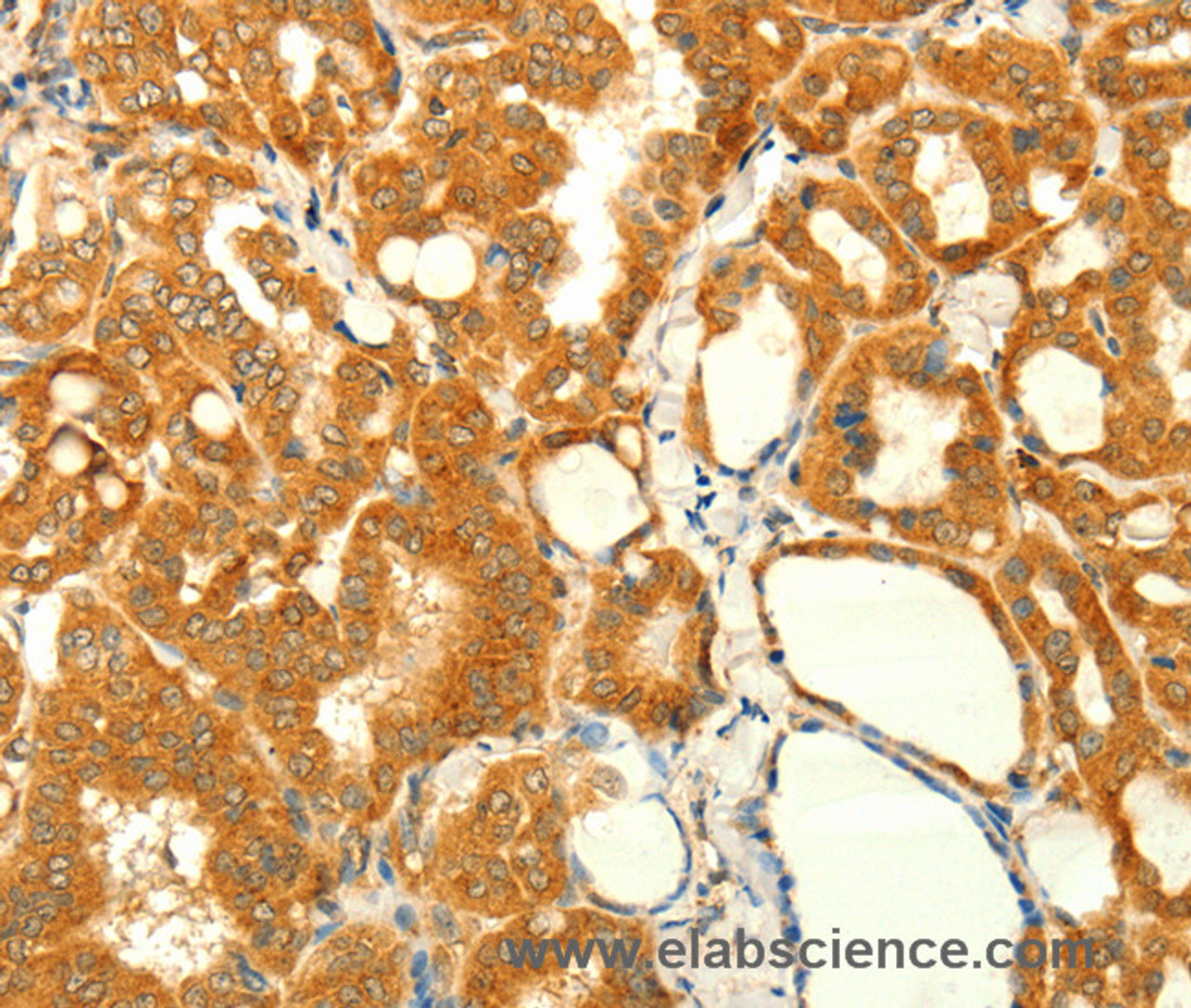 Immunohistochemistry of paraffin-embedded Human thyroid cancer using NAPA Polyclonal Antibody at dilution of 1:35
