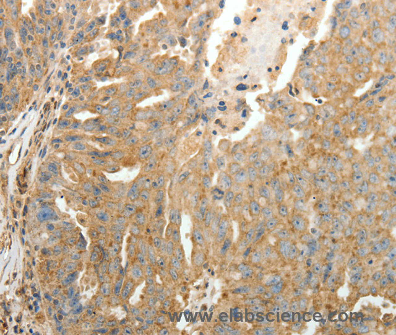 Immunohistochemistry of paraffin-embedded Human ovarian cancer tissue using SFTPD Polyclonal Antibody at dilution 1:30