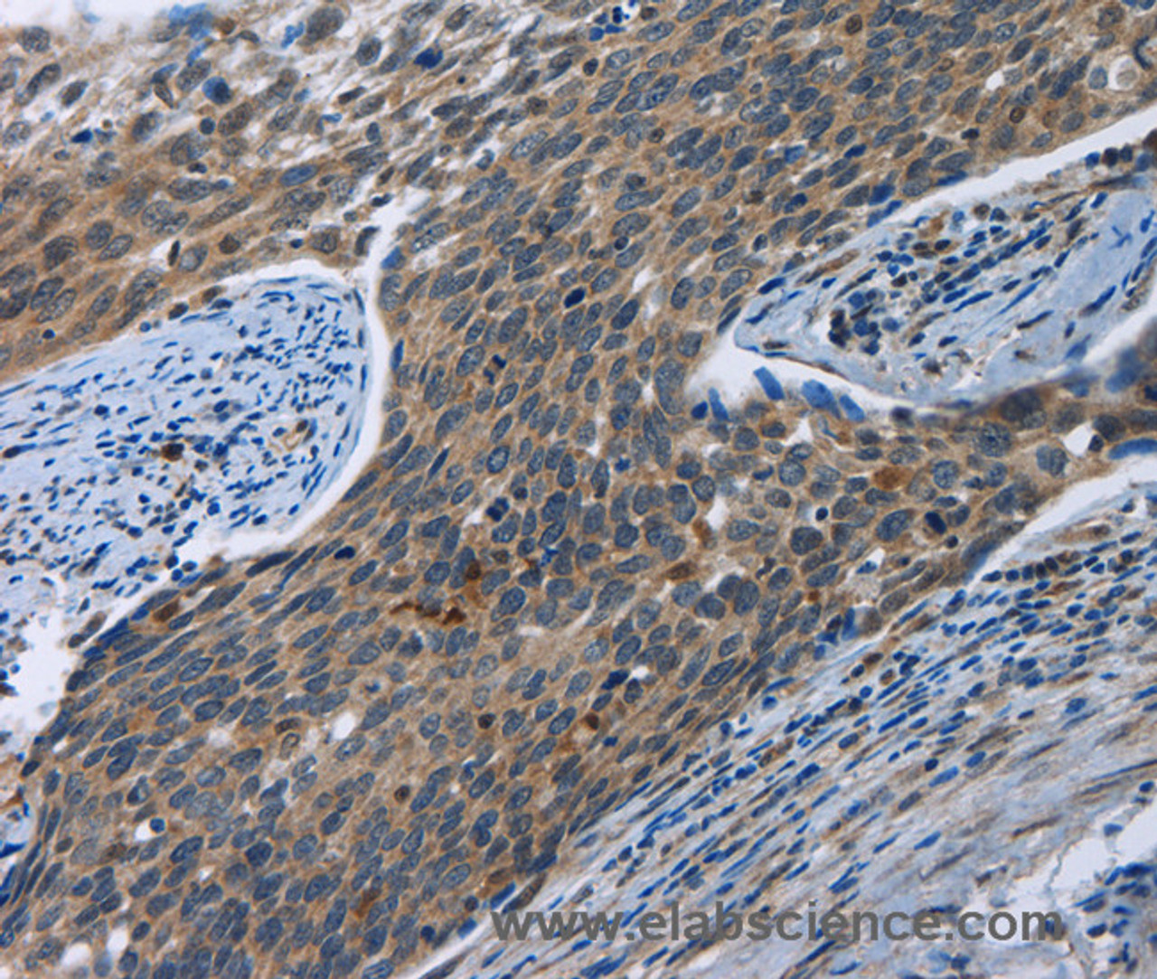 Immunohistochemistry of paraffin-embedded Human cervical cancer tissue using SYT3 Polyclonal Antibody at dilution 1:40