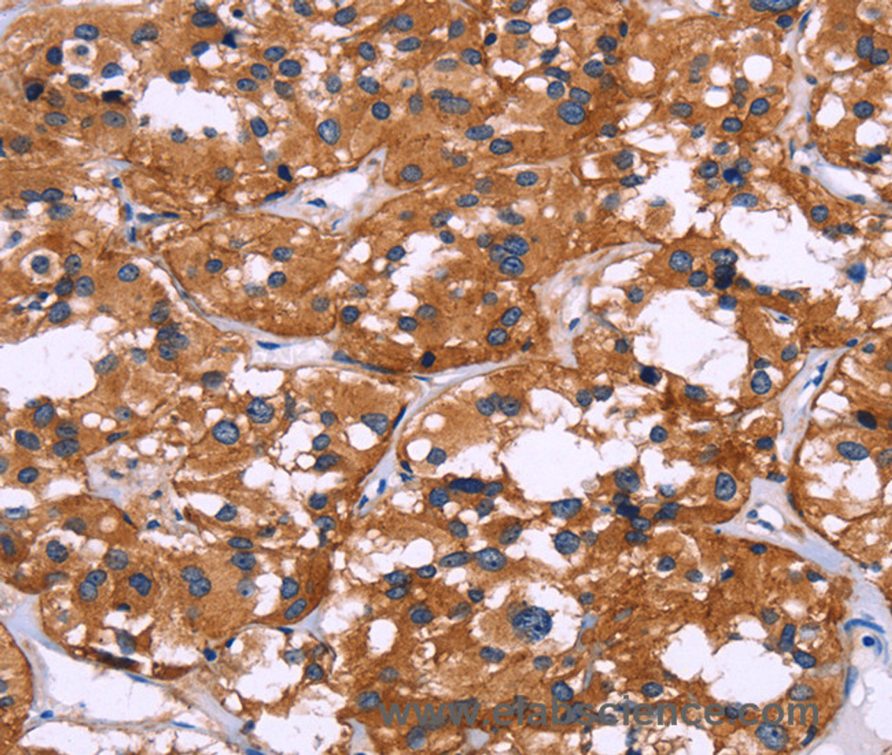 Immunohistochemistry of paraffin-embedded Human thyroid cancer tissue using SYT4 Polyclonal Antibody at dilution 1:60