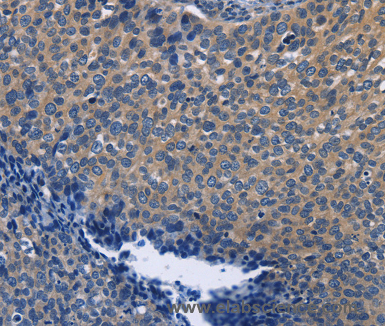 Immunohistochemistry of paraffin-embedded Human cervical cancer using SYT17 Polyclonal Antibody at dilution of 1:60