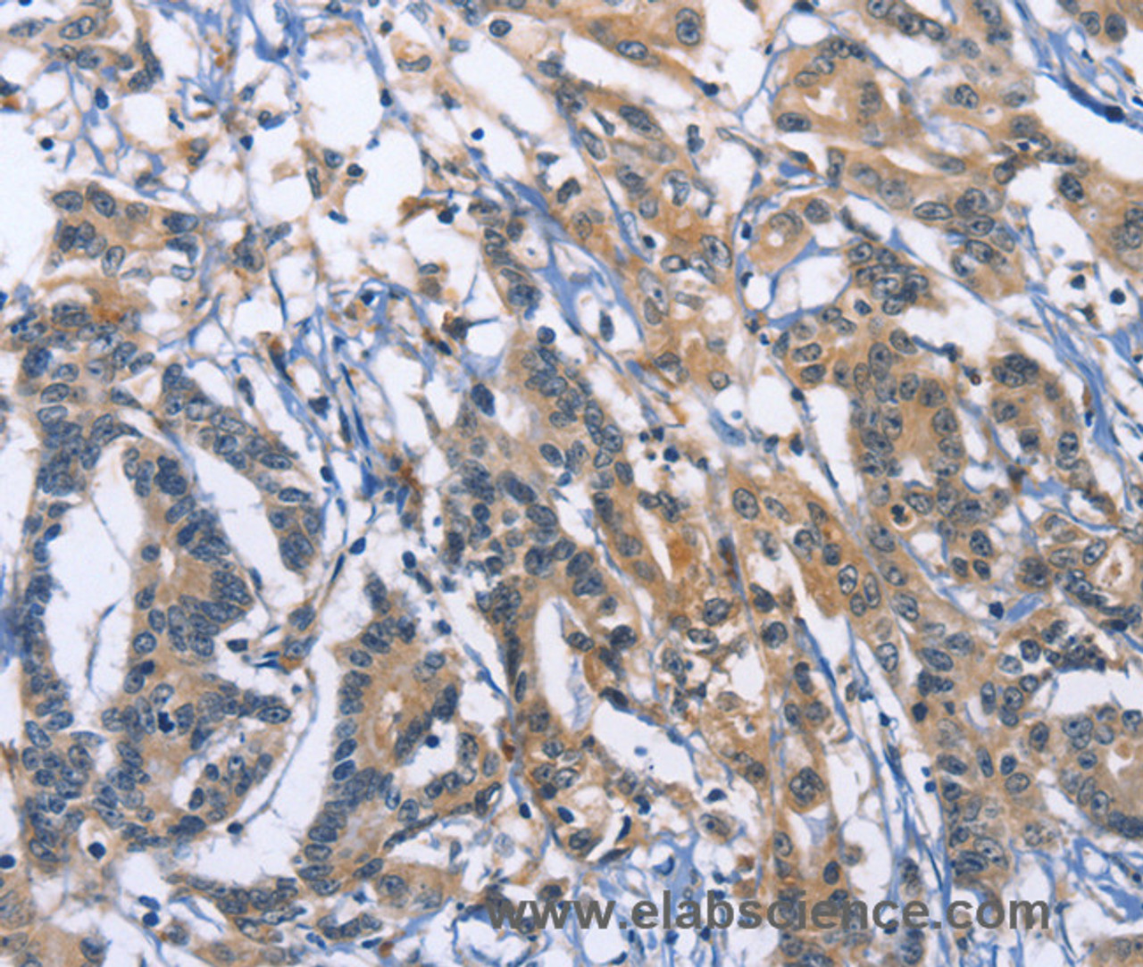 Immunohistochemistry of paraffin-embedded Human colon cancer using SYT17 Polyclonal Antibody at dilution of 1:60